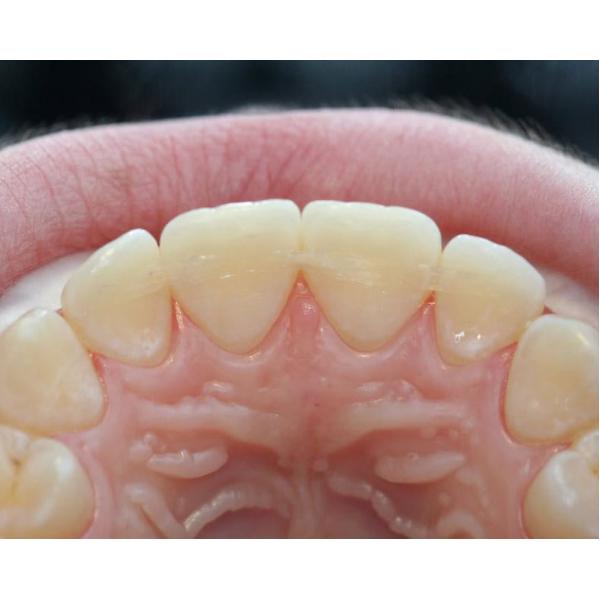 Dentapreg SFM - 1 pásek 6 cm