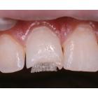 Dentapreg Bridge UFM - 6,0x0,1mm 3 ks